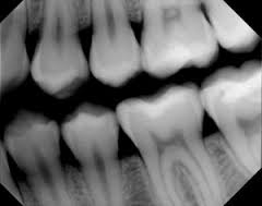 Orthodontic X-Rays