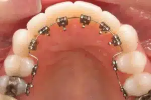 Close-up of dental braces inside mouth