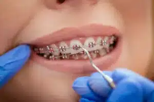 Close-up of braces on teeth