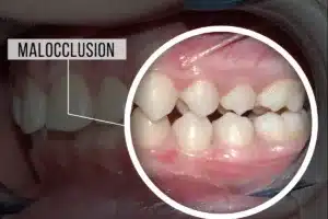 Close-up of dental malocclusion condition