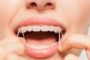 Person adjusting braces with rubber bands