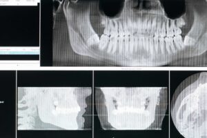 xray for jaw