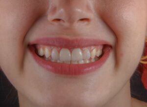 showing teeth with smile