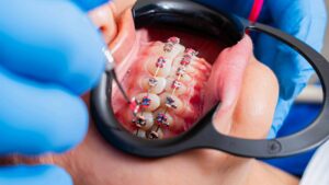 upclose of braces and elastics on patient