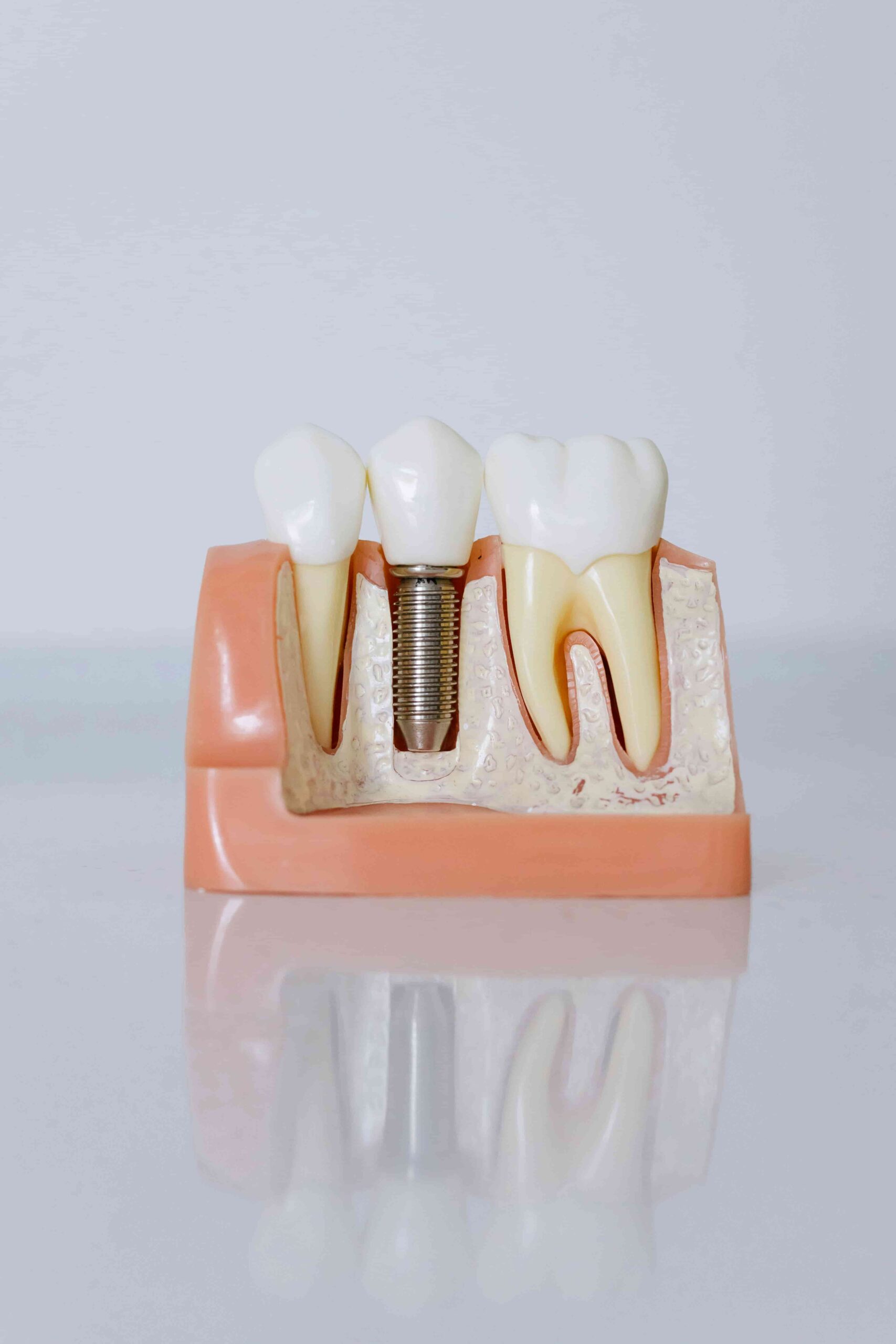 Is it Common to Get a Cavity After Braces? Expert Advice 6 tooth display from cavities