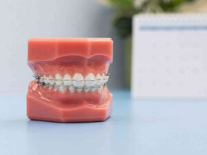 clear aligners on model teeth